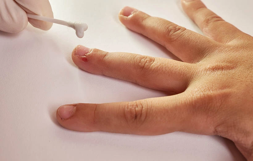 Заусенцы: причины и лечение Заусенцы: причины и лечение