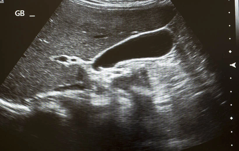 Анэмбриония: причины, симптомы, последствия Анэмбриония: причины, симптомы, последствия