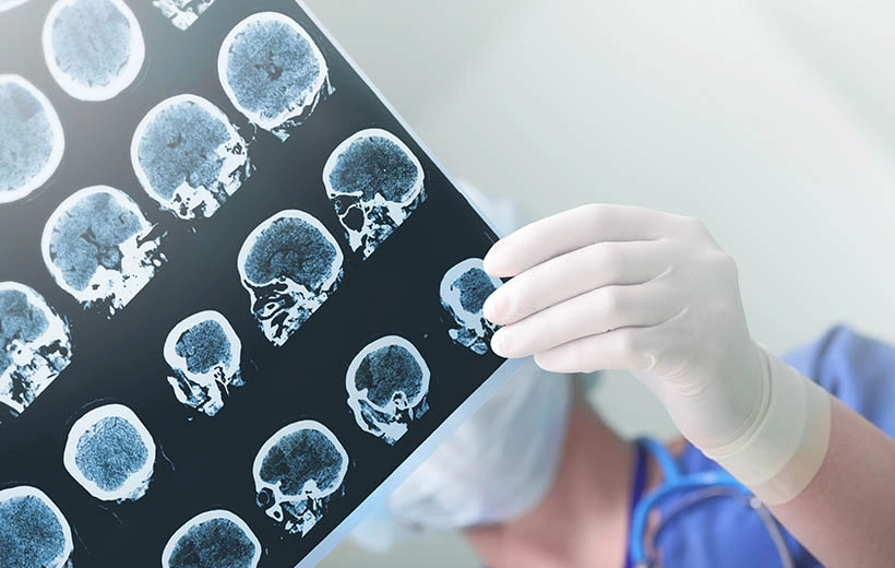 Ишемия головного мозга: симптомы, степени, лечение Ишемия головного мозга: симптомы, степени, лечение