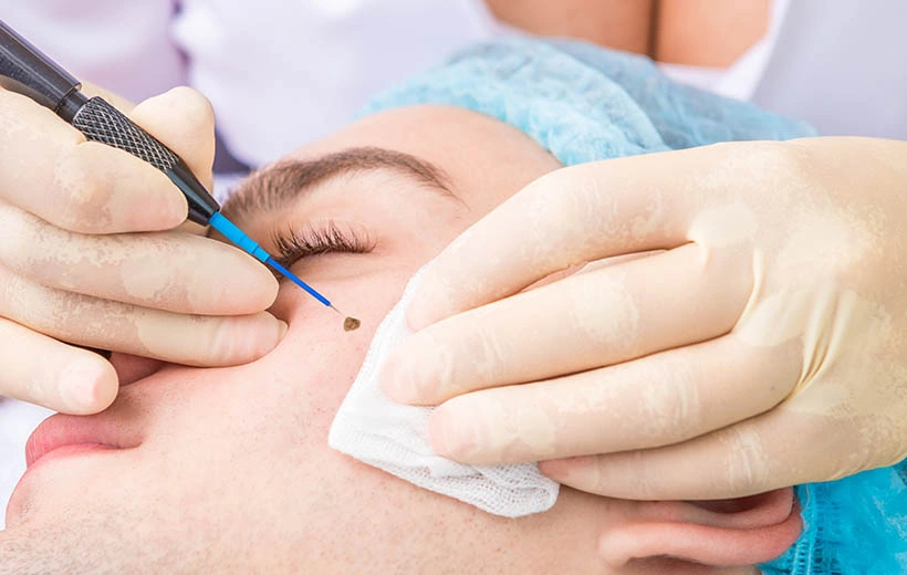 Базалиома: симптомы, стадии, лечение (удаление)